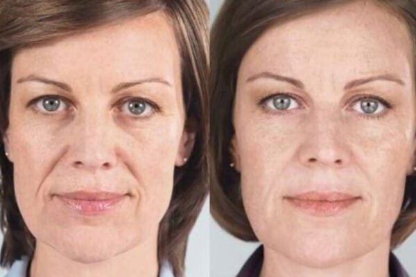 Turn Back The Clock without Surgery