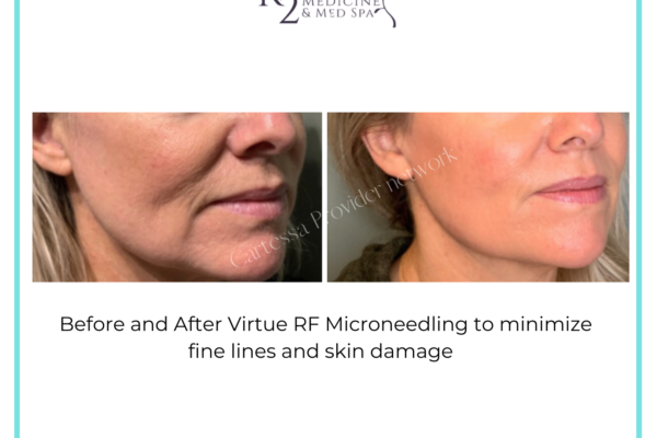 Virtue RF Microneedling Treatment
