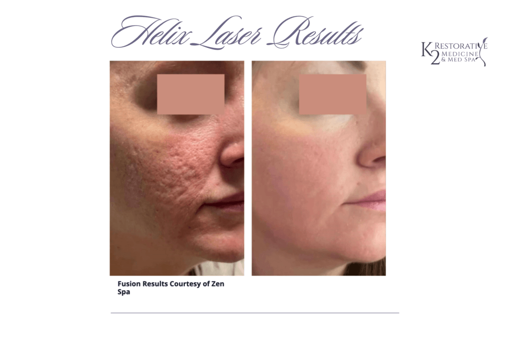Helix Laser Result Helix Laser Skin Resurfacing result at K2 Medicine