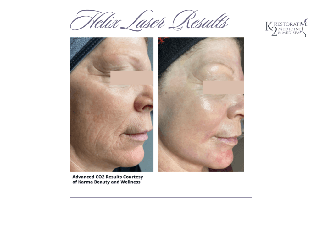 Helix Laser Results.. Helix Laser Results - K2 Medicine