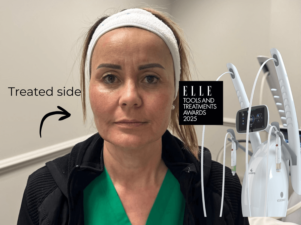 Everesse RF at K2 Restorative Medicine and Med Spa