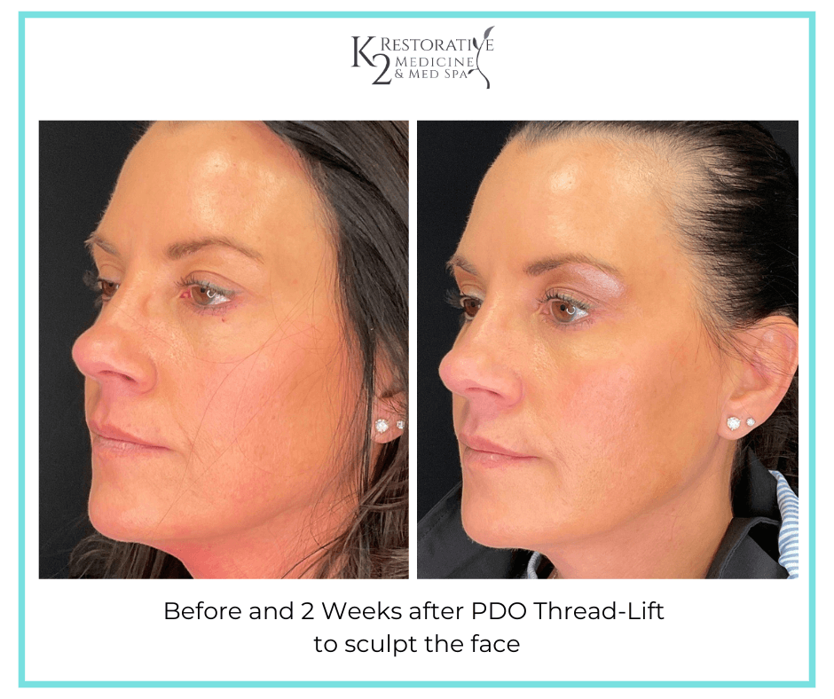 Before and 2 Weeks after PDO Thread-Lift to sculpt the face Before and 2 Weeks after PDO Thread-Lift to sculpt the face