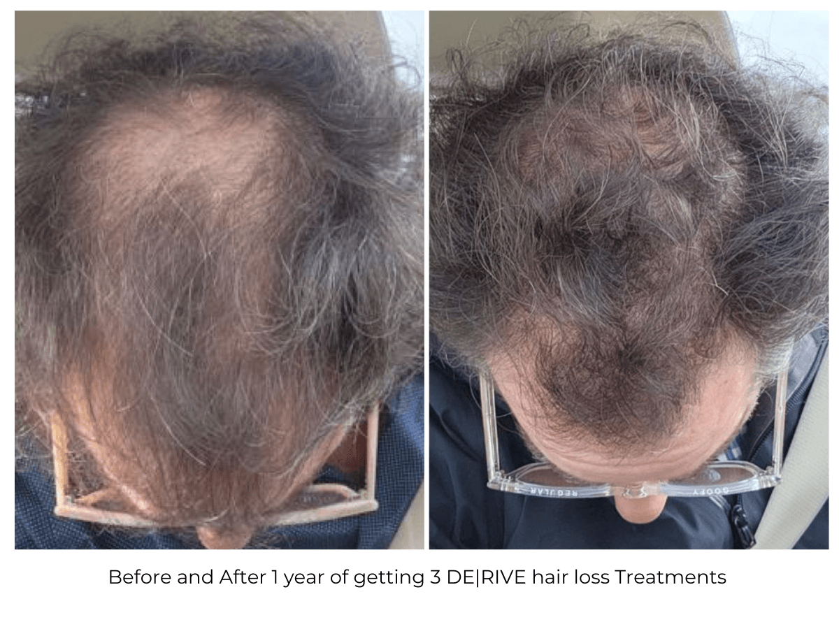 Before and After_ 1 Year Post Initial DE|RIVE Hair Growth Treatment