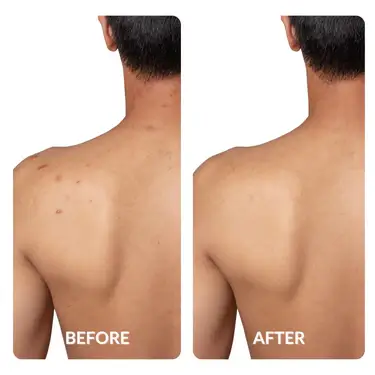Before and After Back Acne with Specatouch Capsule Light Therapy