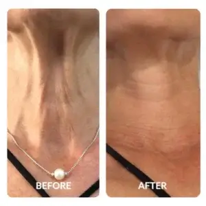 Before and After with SpaceTouch Capsule Light Therapy