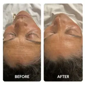 Before and After aging Results by Spacetouch Capsule Light Therapy