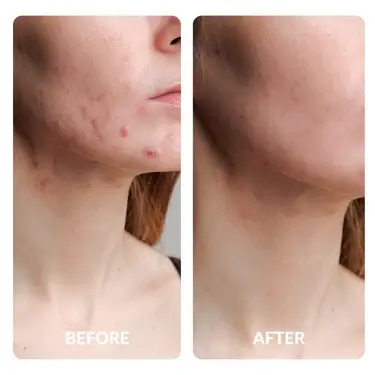 Before and After Face Acne with SpaceTouch Capsule Light Therapy