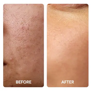 Before and After Skin Texture from SpaceTouch Capsule in Trussville, AL