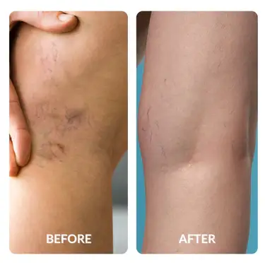 Before and After Vein Treatment with Spacetouch Capsule Therapy