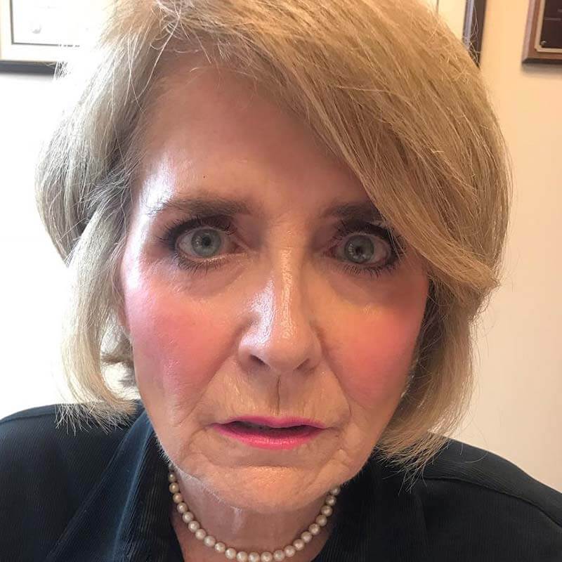 5 Months After Vampire Facelift