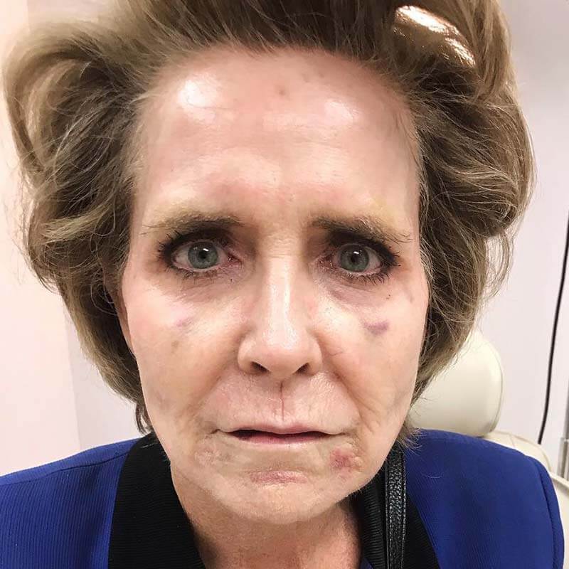 Immediately After Vampire Facelift