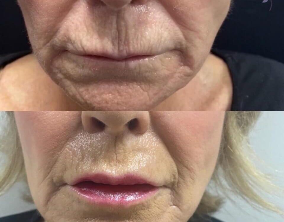 Before and After Plasma Pen Treatment