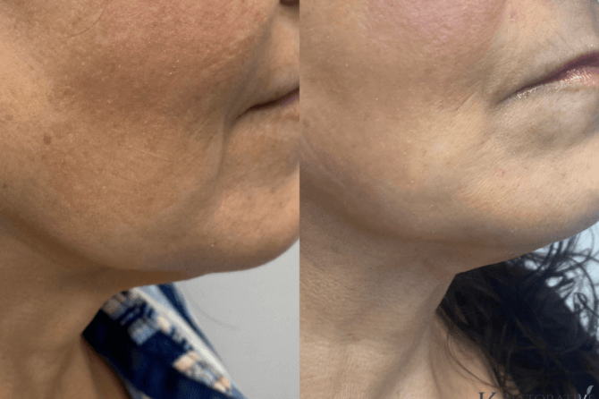 Tighten, lift, and reshape Face & Body with the help of the PDO Thread Lift