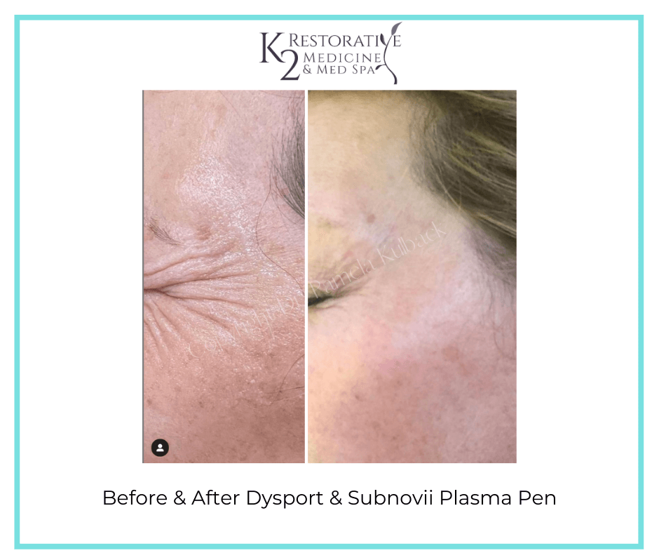 Before and after Dysport and Subnovii - K2 Restorative Medicine