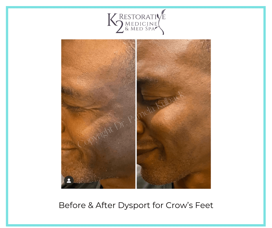 Before and after Dysport for Crows feet - K2 Restorative Medicine