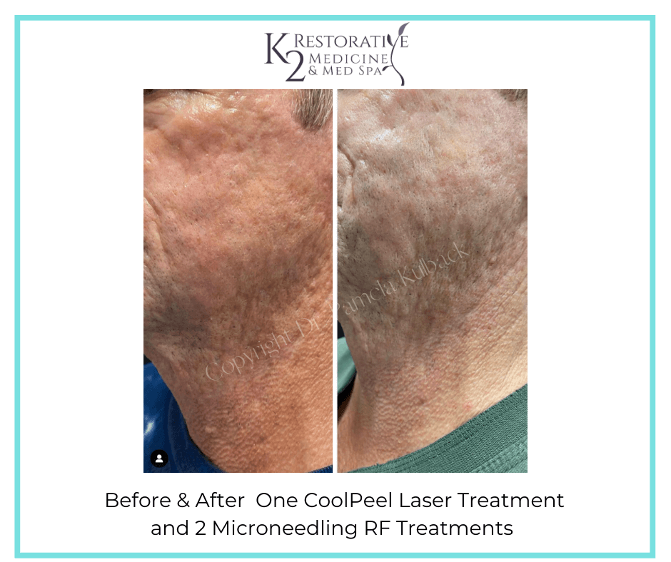 One CoolPeel Laser Treatment and 2 Microneedling RF Treatments Before and After - K2 Restorative Medicine