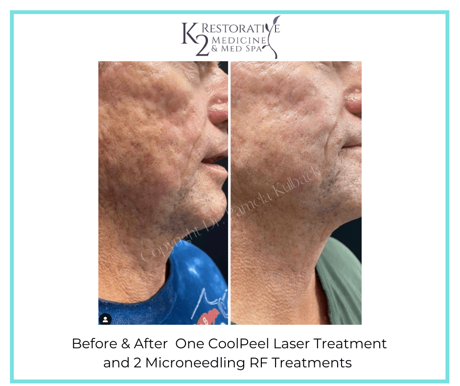 One CoolPeel Laser Treatment and 2 Microneedling RF Treatments Before and After - K2 Restorative Medicine