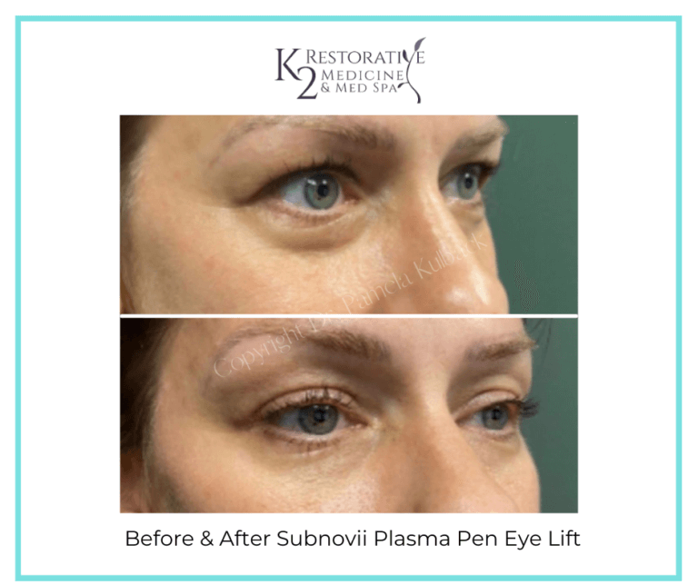 Opt for Subnovii Plasma Pen Treatments for Beautiful Skin