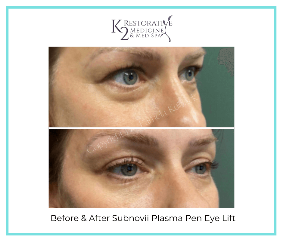Plasma Skin Resurfacing & Skin Tightening TreatmentBefore and After - K2 Restorative Medicine (1)