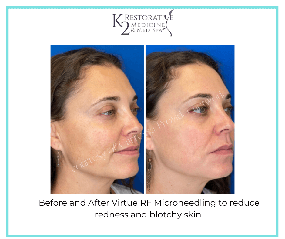 Before and After Virtue RF Microneedling Results - K2 Restorative Medicine