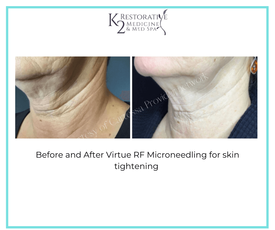 Before and After Virtue RF Microneedling Results- K2 Restorative Medicine