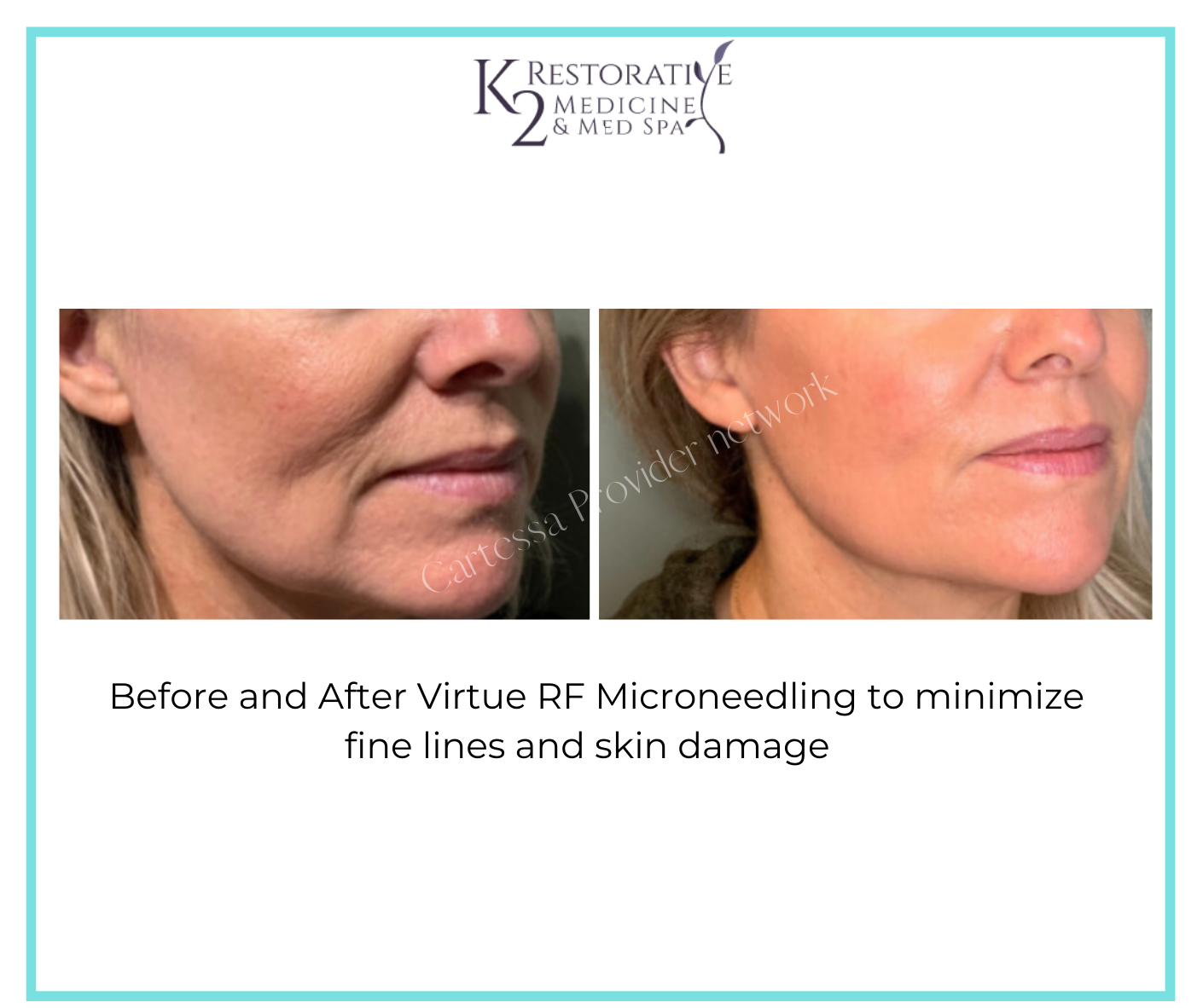 Before and After Virtue RF Microneedling Results