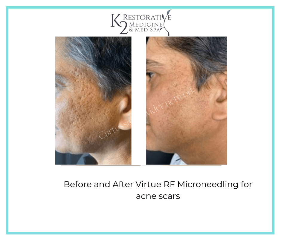 Before and After Virtue RF Microneedling Results - K2 Restorative Medicine