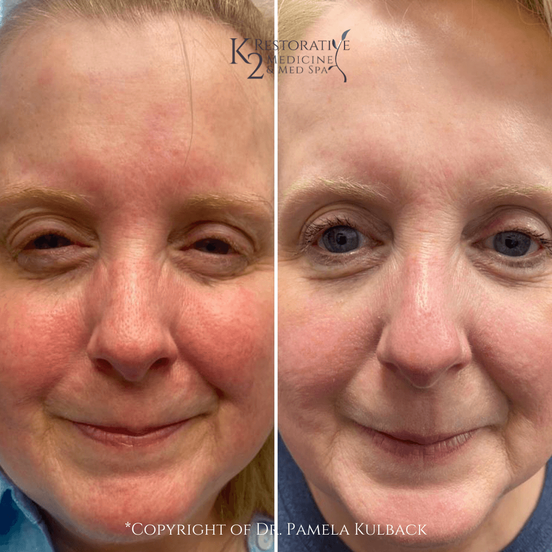 Before & after 1 IPL treatment to treat Rosacea, (redness), broken blood vessels, & uneven skin tone