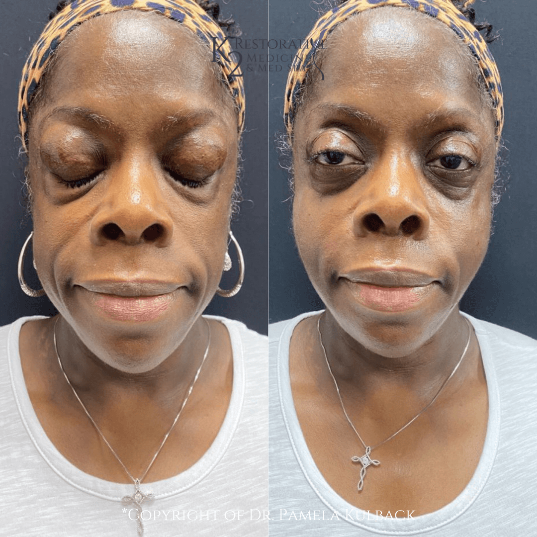 Combination Filler & PRP Treatment by Dr. Pamela Kulback - K2 Restorative Medicine