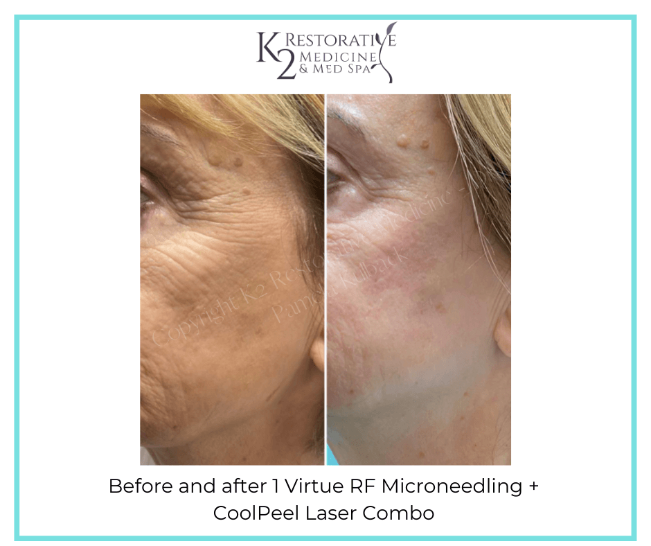 Before and after 1 Virtue RF Microneedling + CoolPeel Laser Combo by Dr. Pamela Kulback