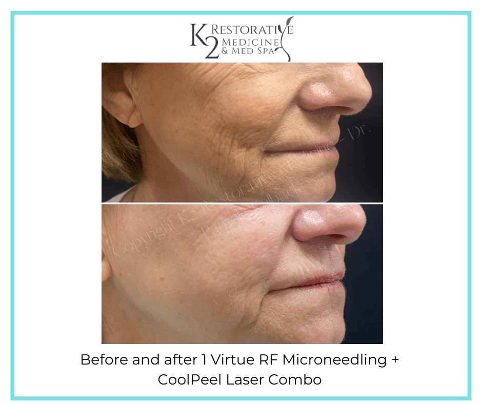 Before and after 1 Virtue RF Microneedling + CoolPeel Laser Combo by Dr. Pamela Kulback