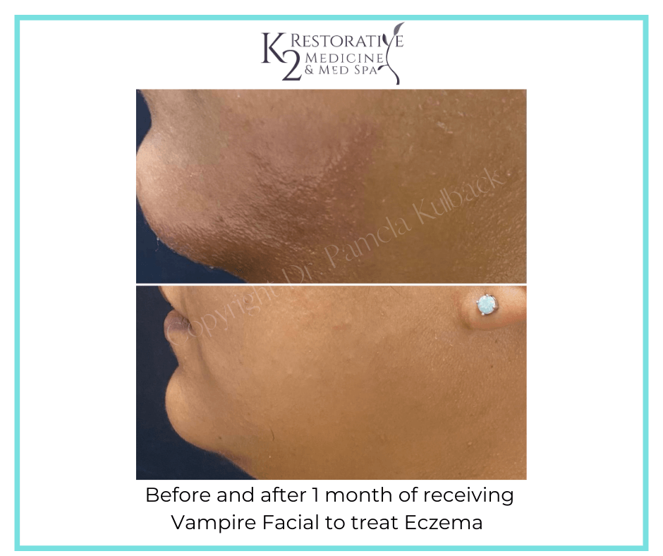 Before and after 1 month of receiving Vampire Facial to treat Eczema  with Dr. Pamela Kulback in Trussville, Alabama Before and after 1 month of receiving Vampire Facial to treat Eczema  with Dr. Pamela Kulback in Trussville, Alabama
