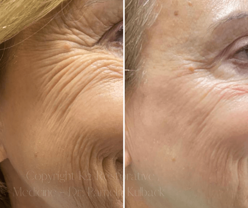 Before and after 1 Virtue RF Microneedling + CoolPeel Laser Combo