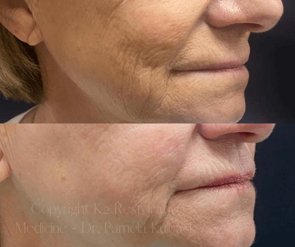 Before and after 1 Virtue RF Microneedling + CoolPeel Laser Combo
