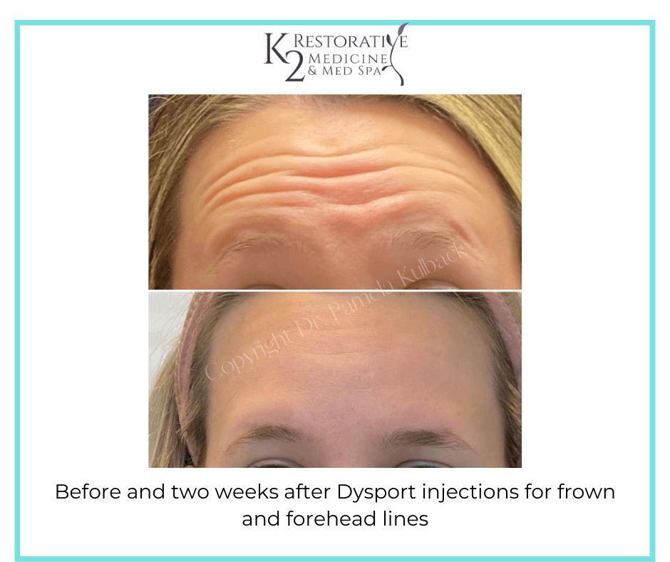 Before and two weeks after Dysport injections for frown and forehead lines - K2 Restorative Medicine Before-and-two-weeks-after-Dysport-injections-for-frown-and-forehead-lines