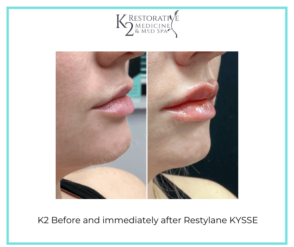 Look Young with Fillers & Injectables Restylane & Juvederm