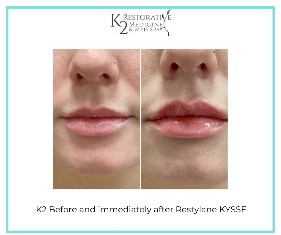 Look Young with Fillers & Injectables Restylane & Juvederm