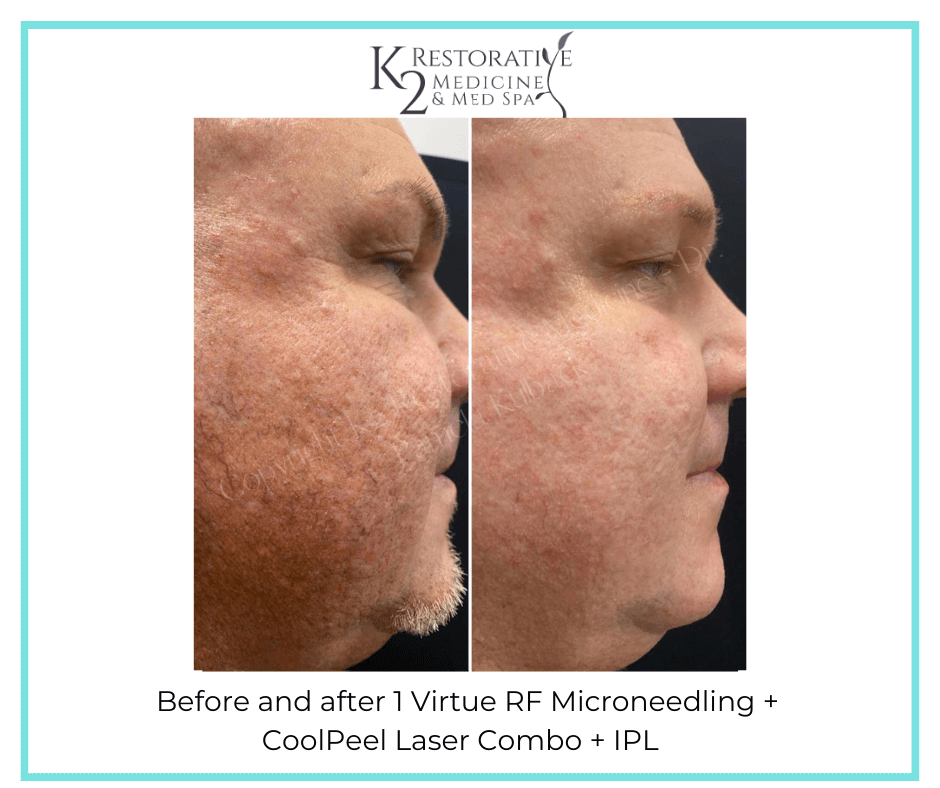 Before and After Virtue RF Microneedling Results