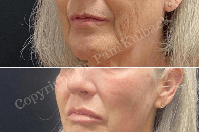 CoolPeel™ Top Skin Resurfacing Laser