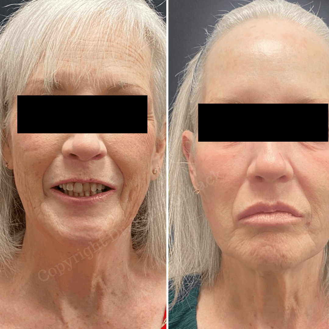 Before and after 4-months of Combination Skin Therapy. Patient received Virtue RF + CoolPeel and IPL, Sculptra, Restylane Kysse to the lips, Dysport , and PDO Thread-Facelift by Dr. Pamela Kulback