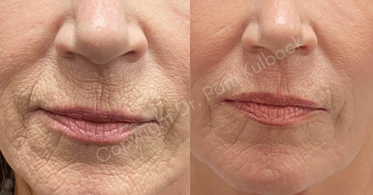 Before and After Coolpeel + Virtue RF + Subnovii Plasma Pen Treatment