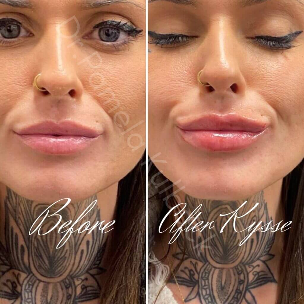 Before and After Kysse Results Before and After Kysse Results