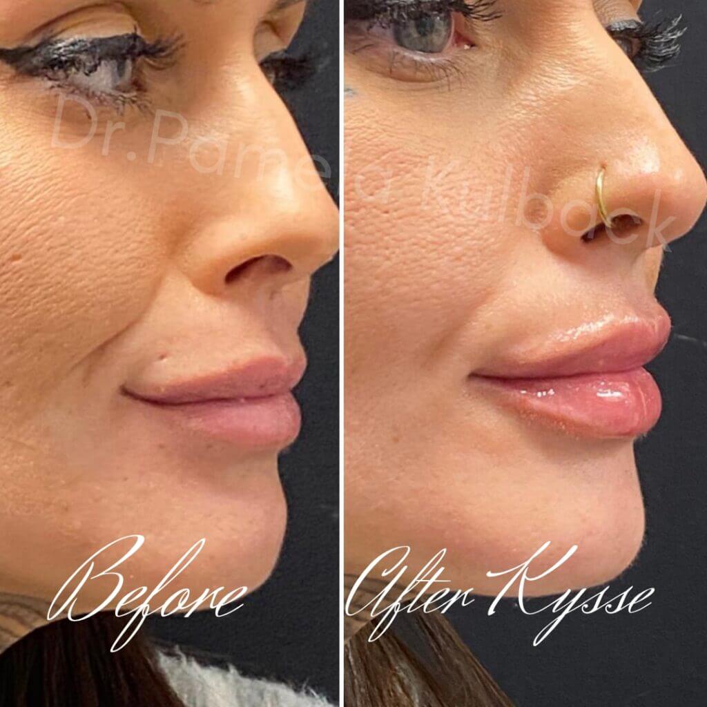 Before and After Kysse Results Before and After Kysse Results