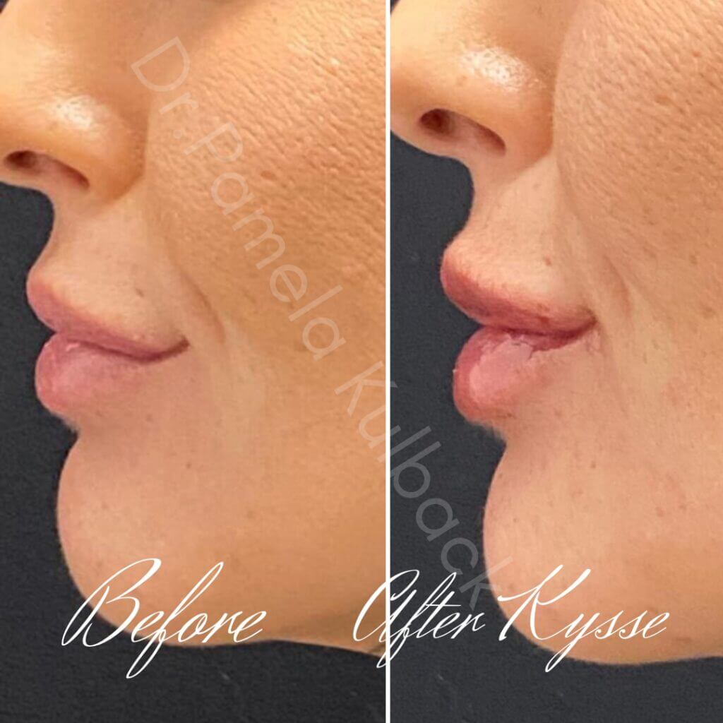 Before and After Kysse Results Before and After Kysse Results