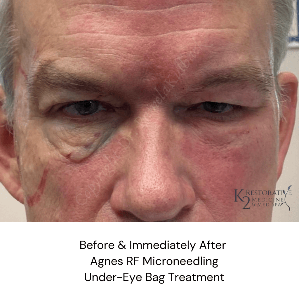 Before & Immediately After Agnes RF Microneedling Under-Eye Bag Treatment