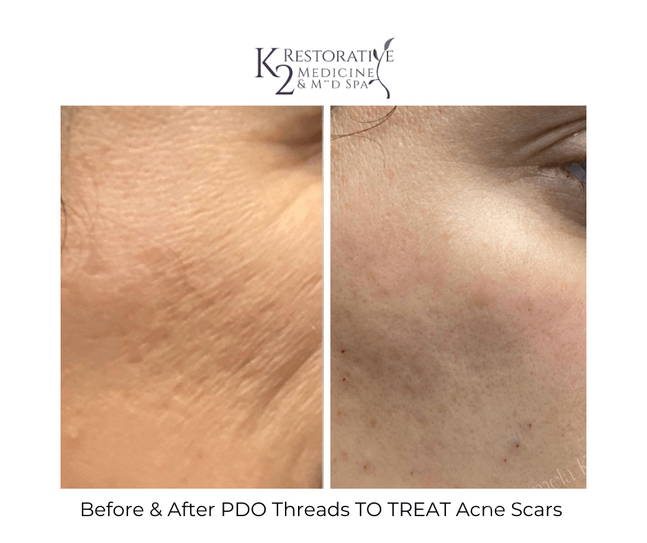 Before & After PDO Threads TO TREAT Acne Scars