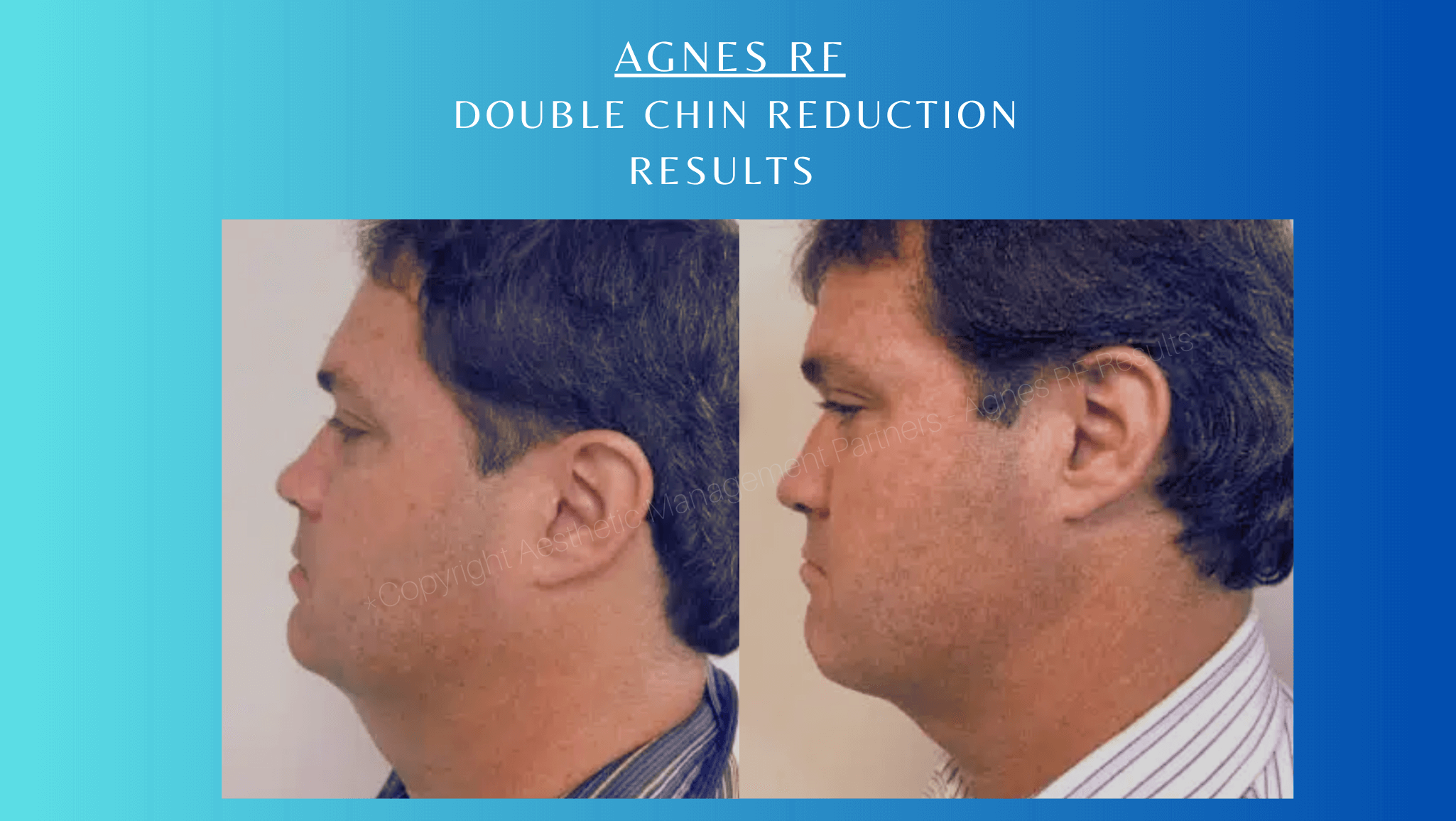 Before and after Double Chin Reduction with Agnes RF