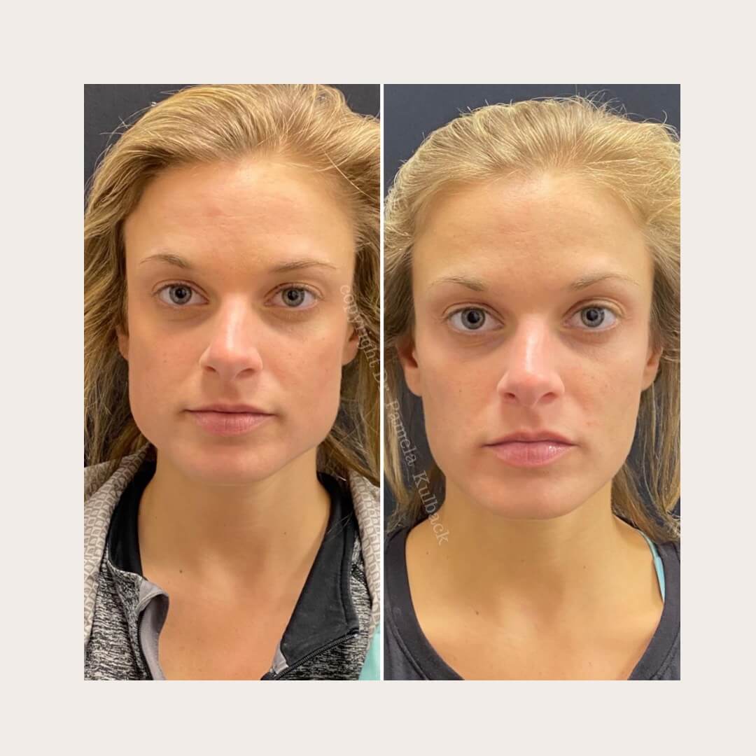 Before and after Botox for TMJ at K2 Medicine