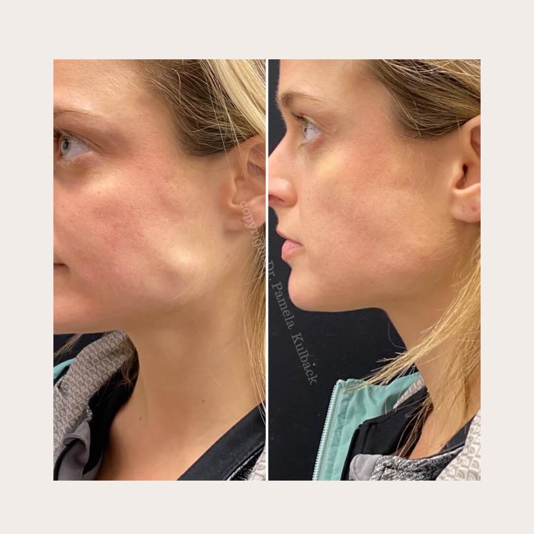 Before and after Botox for TMJ at K2 Medicine