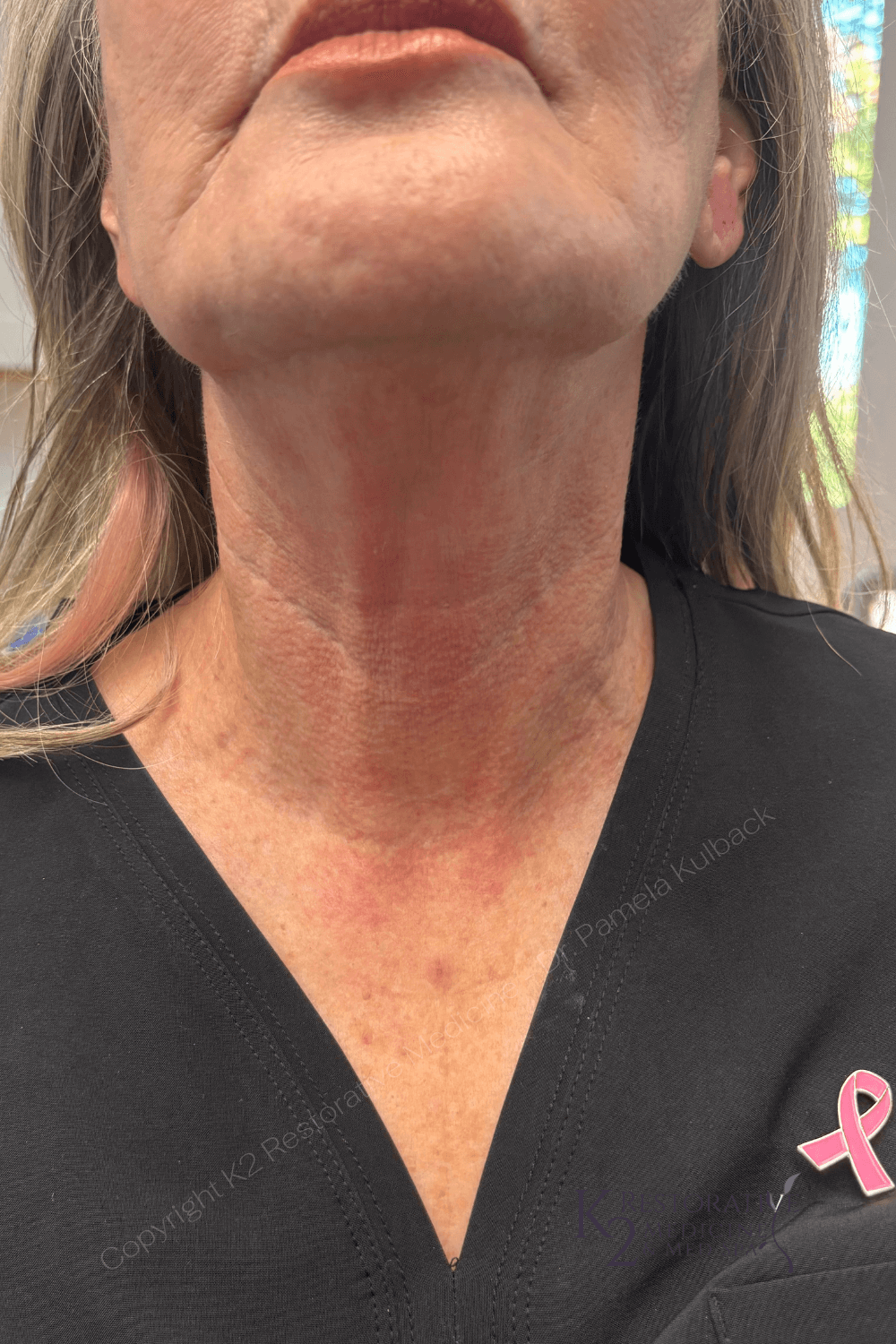 30 Minutes After Virtue RF Results at K2 Restorative Medicine and Med Spa By Dr Kulback